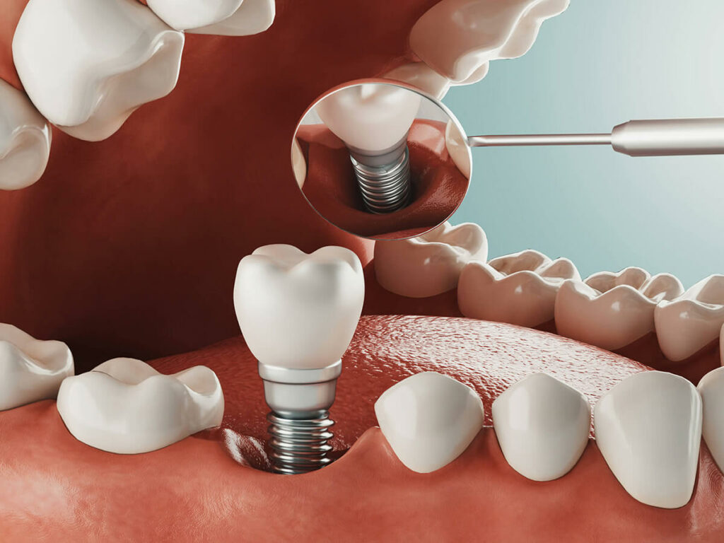 dental implant insert in jaw