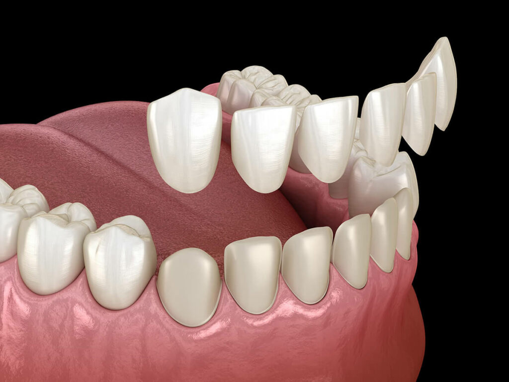 dental veneer above teeth