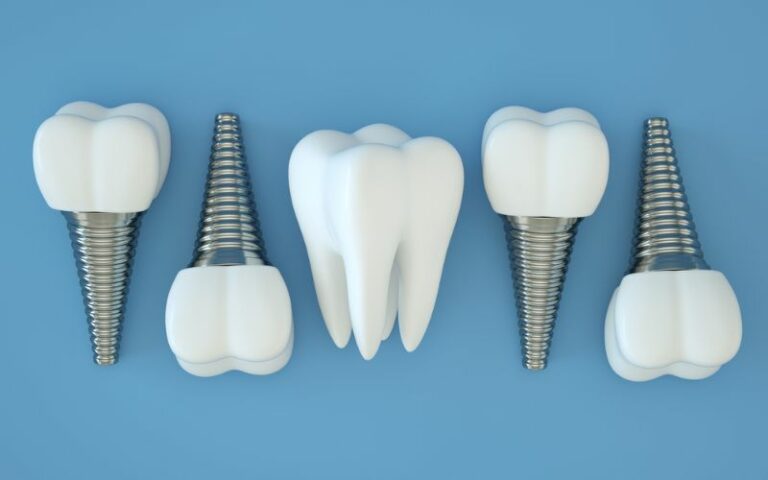 dental implants arranged top to bottom