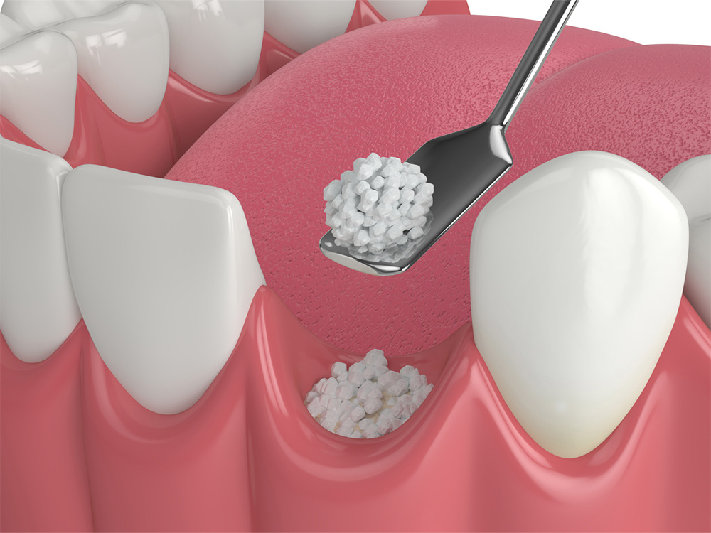 bone graft being placed in gum