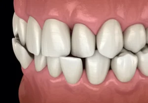 crossbite graphic