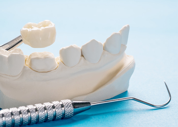 The image shows a dental model with a dental crown being held by a pair of tweezers above the model. There is also a dental tool, specifically a dental explorer, placed in the foreground.