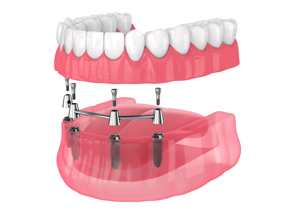 all-on-4 dental implants fitting into jaw graphic