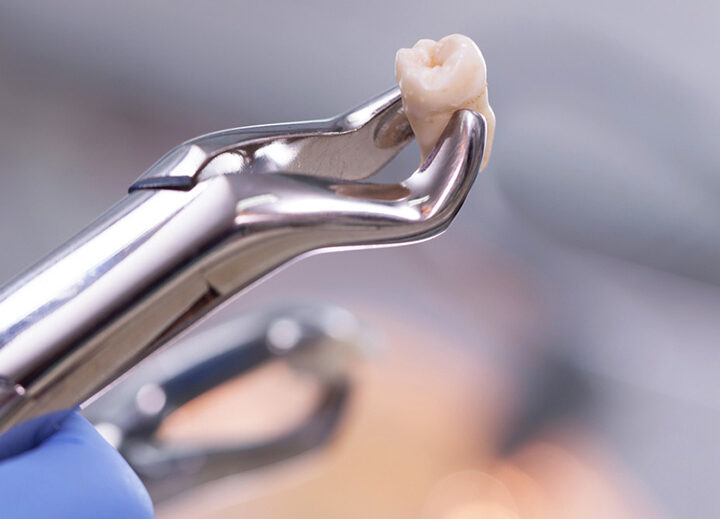 Close-up of a dental extraction tool holding a removed molar with visible roots; background blurred, indicating a clinical setting.
